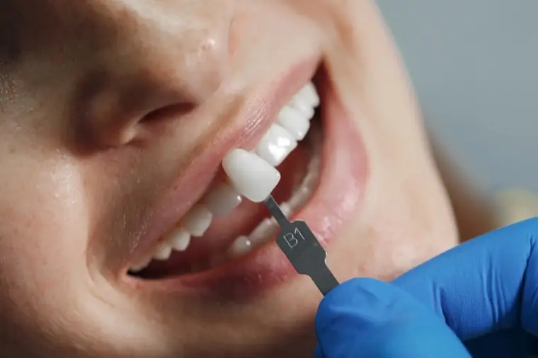 Carillas cerámicas sobre dientes anteriores