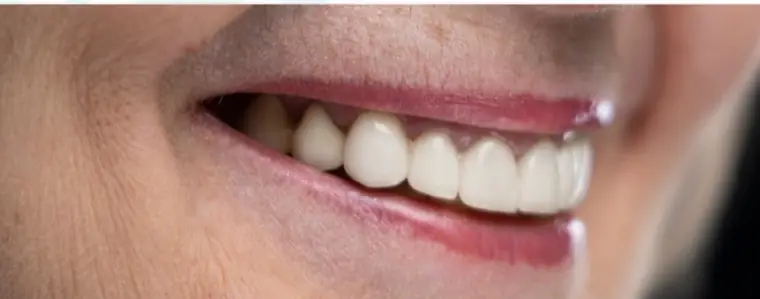 Sonrisa rehabilitada con puente cerámico